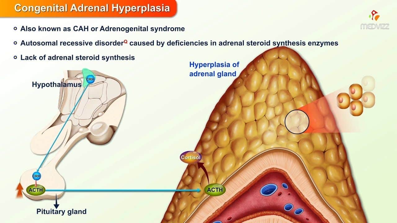 Congenital Adrenal Hyperplasia