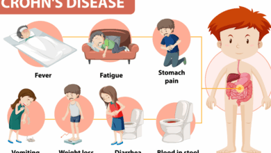 Crohn's Disease