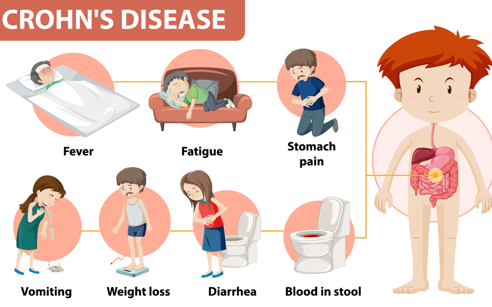 Crohn's Disease