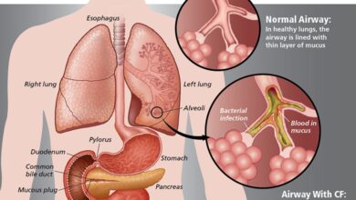 Cystic Fibrosis