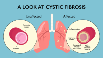 Cystic Fibrosis