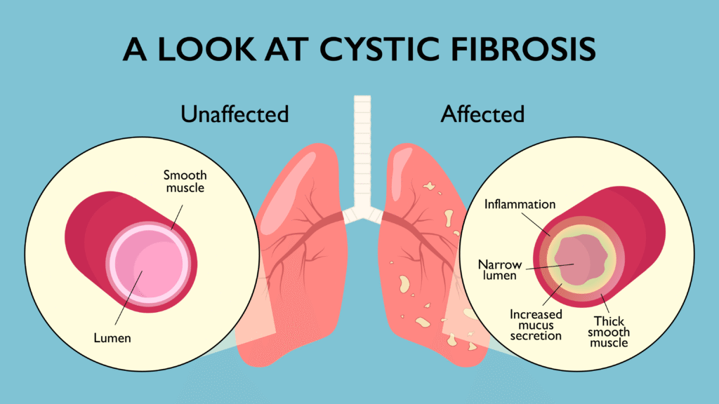 Cystic Fibrosis