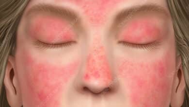 Dermatomyositis