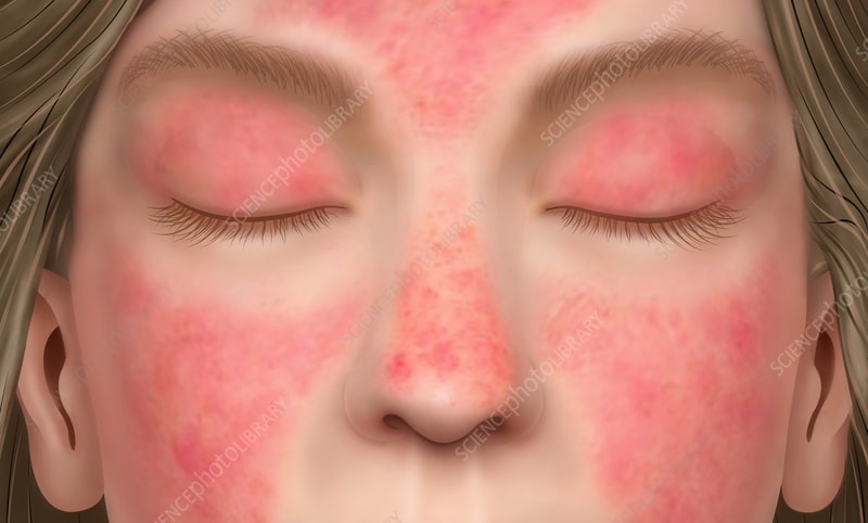 Dermatomyositis