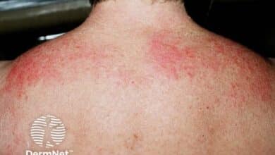 Dermatomyositis
