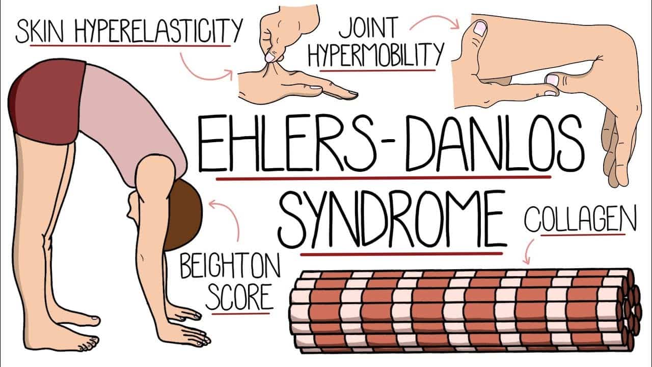 Ehlers-Danlos Syndrome