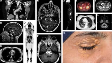 Erdheim-Chester Disease