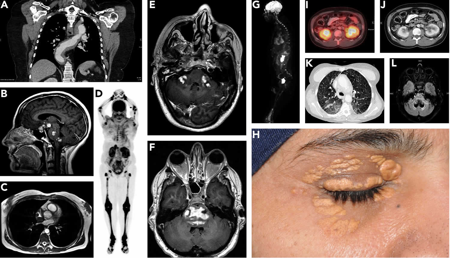 Erdheim-Chester Disease