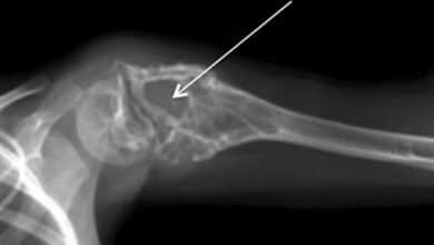 Ewing Sarcoma: A Rare Bone and Soft Tissue Cancer Affecting Young People
