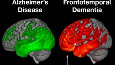 Frontotemporal Dementia (FTD)