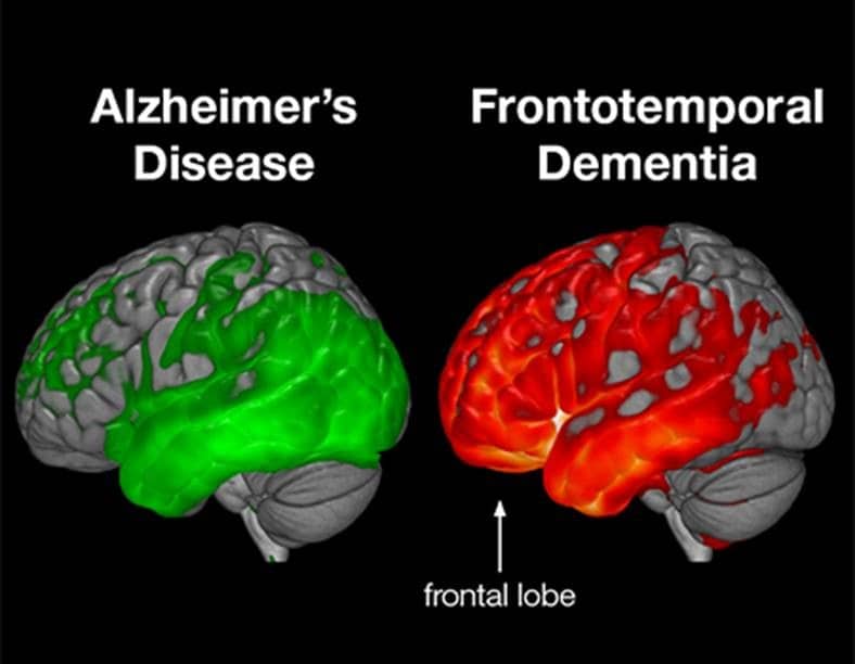 Frontotemporal Dementia (FTD)