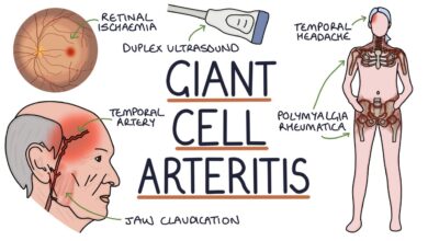 Giant Cell Arteritis