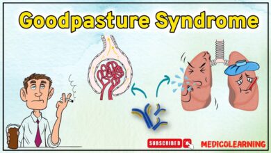 Goodpasture Syndrome