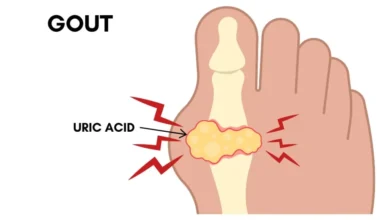 Gout