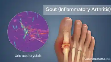 Gout
