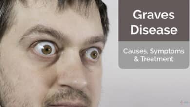 Graves' Disease