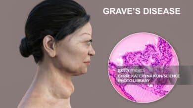 Graves' Disease