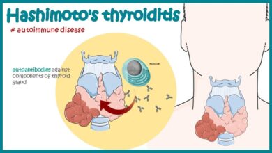 Hashimoto's Thyroiditis