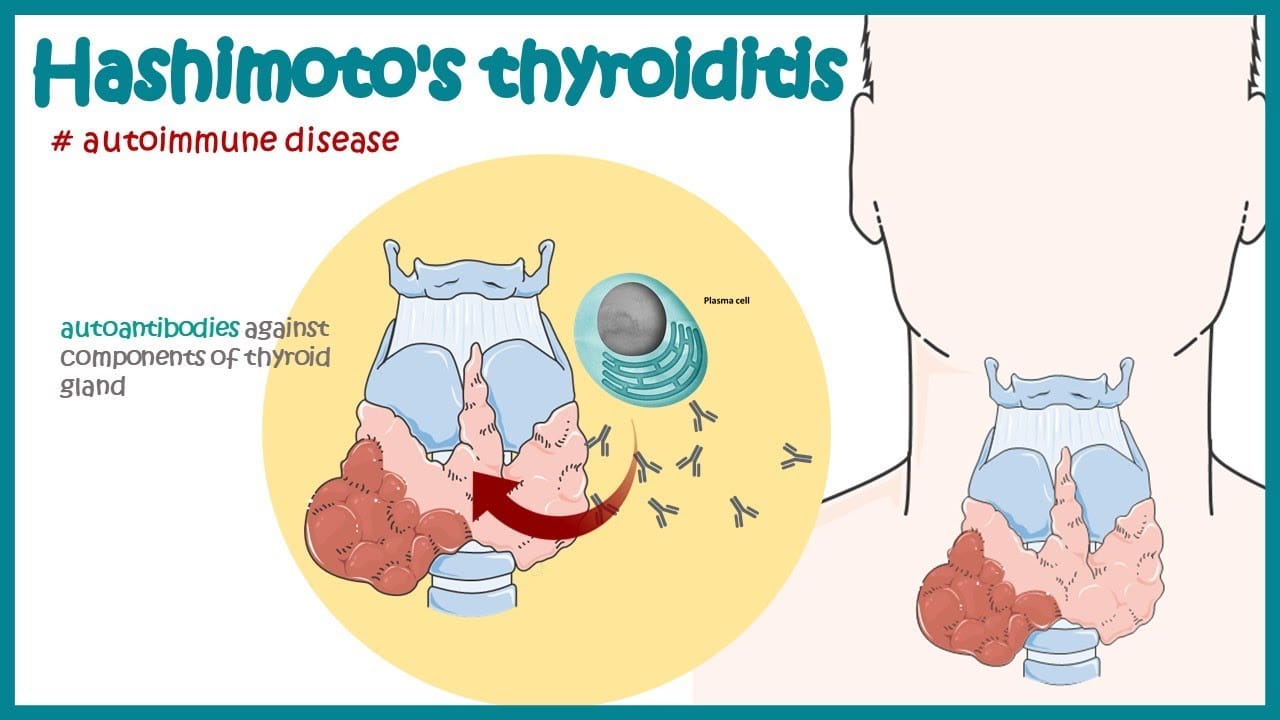Hashimoto's Thyroiditis