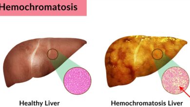 Hemochromatosis