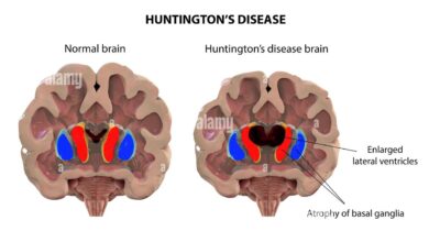 Huntington's Disease