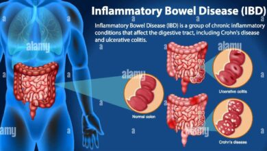 Inflammatory Bowel Disease (IBD)