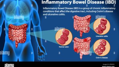 Inflammatory Bowel Disease (IBD)