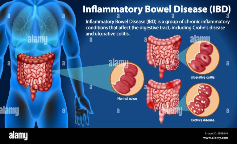 Inflammatory Bowel Disease (IBD): Crohn's Disease vs Ulcerative Colitis ...