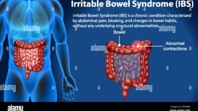 Irritable Bowel Syndrome (IBS)