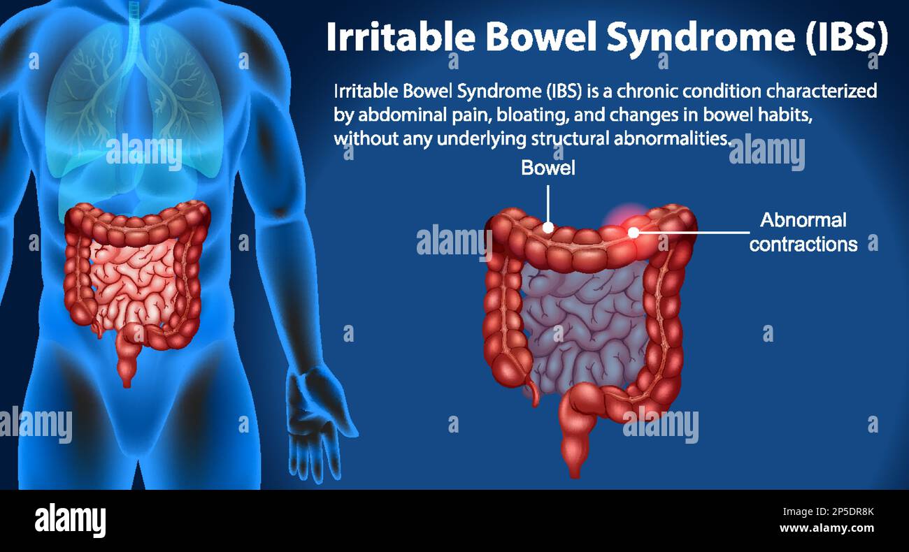 Irritable Bowel Syndrome (IBS)