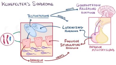 Klinefelter Syndrome (XXY)