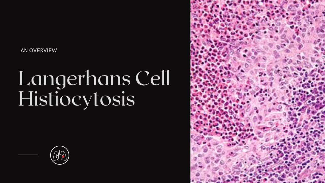 Langerhans Cell Histiocytosis