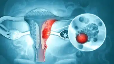 Leiomyosarcoma: What You Need to Know About This Smooth Muscle Cancer