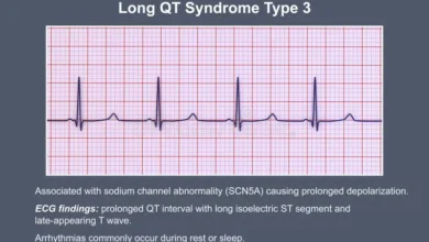 Long QT Syndrome