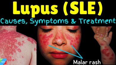 Lupus (SLE)