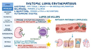 Lupus (SLE)