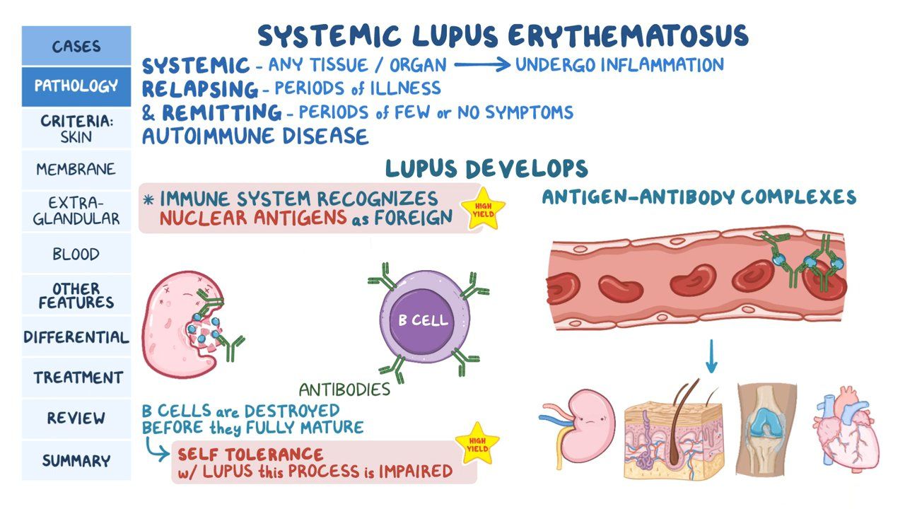 Lupus (SLE)