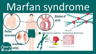 Marfan Syndrome