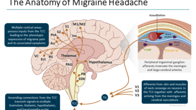 Migraine Disease