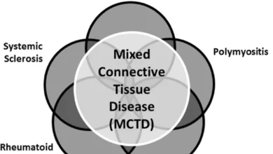 Mixed Connective Tissue Disease