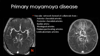 Moyamoya Disease