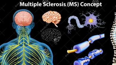 Multiple Sclerosis
