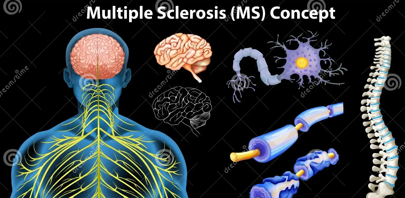 Multiple Sclerosis