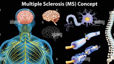 Multiple Sclerosis