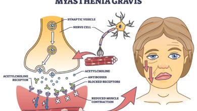 Myasthenia Gravis