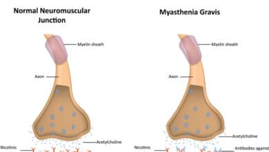 Myasthenia Gravis