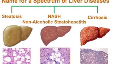 NASH (Non-Alcoholic Steatohepatitis)