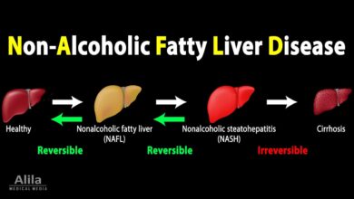 Non-Alcoholic Fatty Liver Disease
