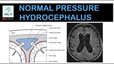 Normal Pressure Hydrocephalus