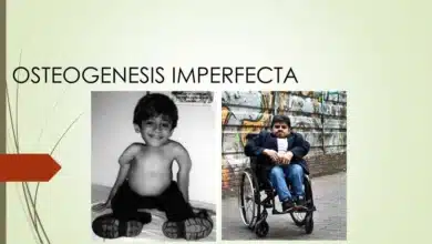 Osteogenesis Imperfecta